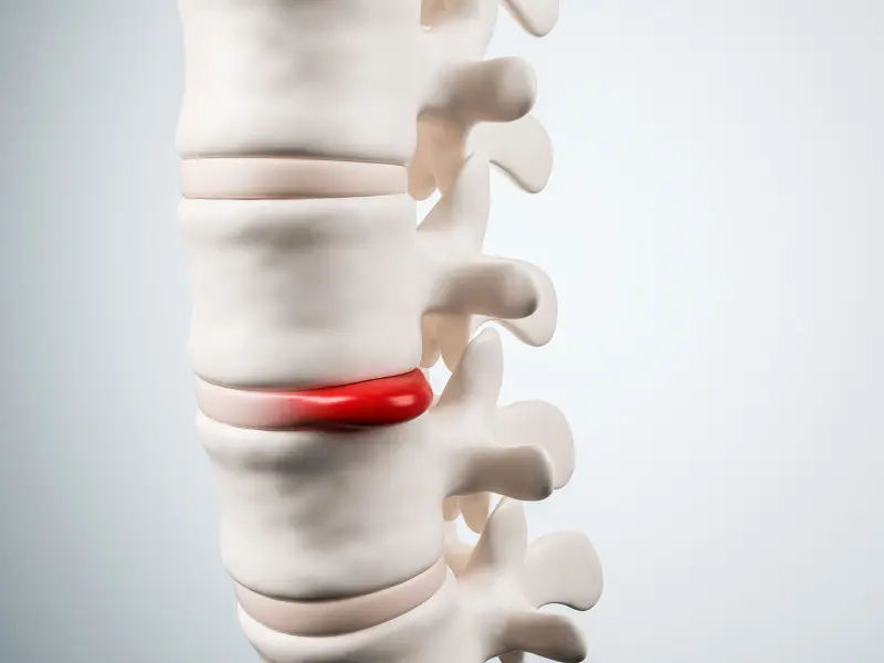 Disc Injury Treatment Near Me in Pace and Milton, FL. Chiropractor For Disc Injury Pain Relief.